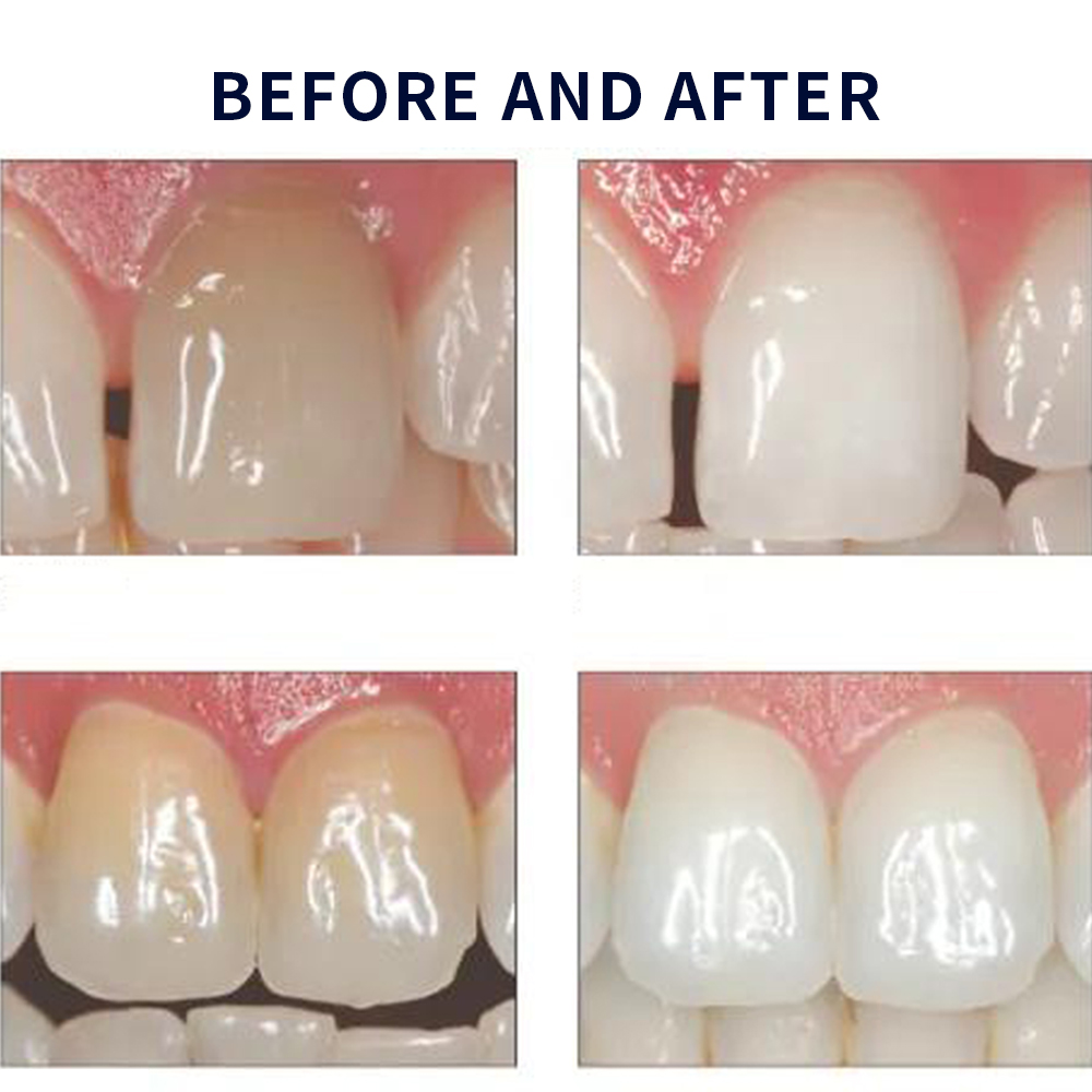 Opalescence Whitening 20% PF 2 - Whitening Mouthwash incelemesi ve fiyatı