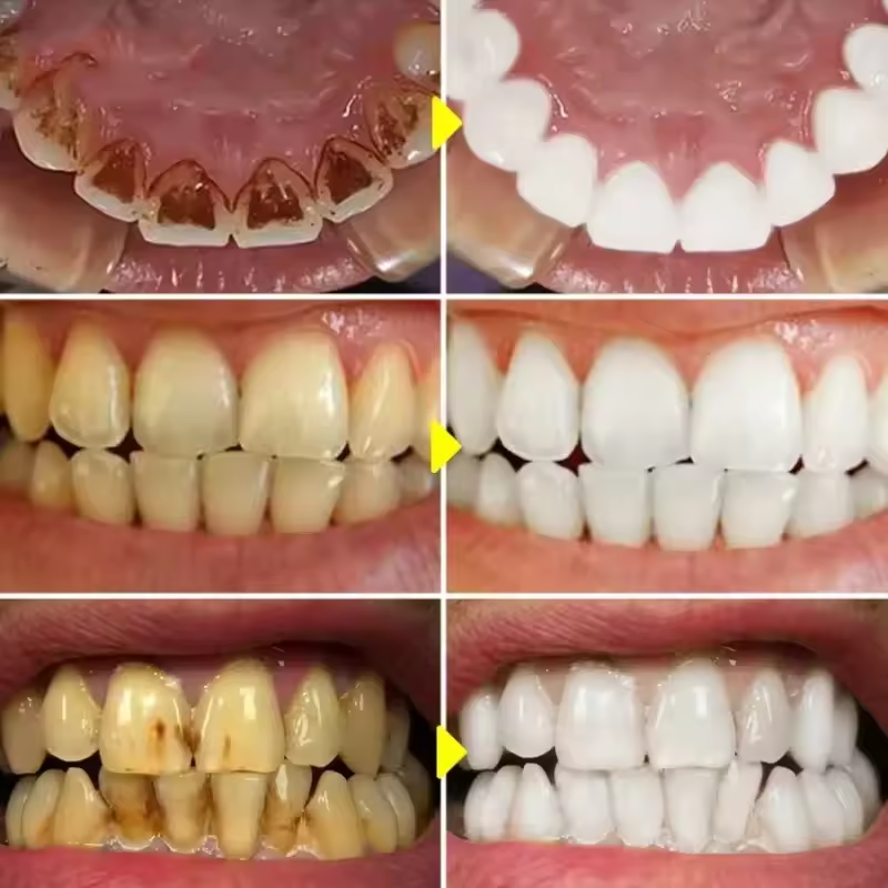 V34 Teeth Whitening Purple Too - Teeth Whitening Crest incelemesi ve fiyatı