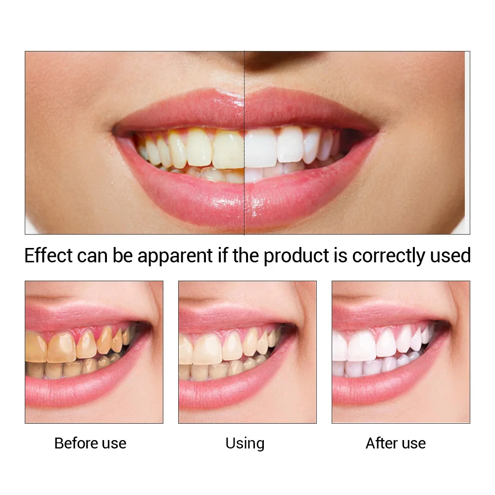 FTEENPLY Teeth Whitening Essen - Teeth Whitening Serum incelemesi ve fiyatı