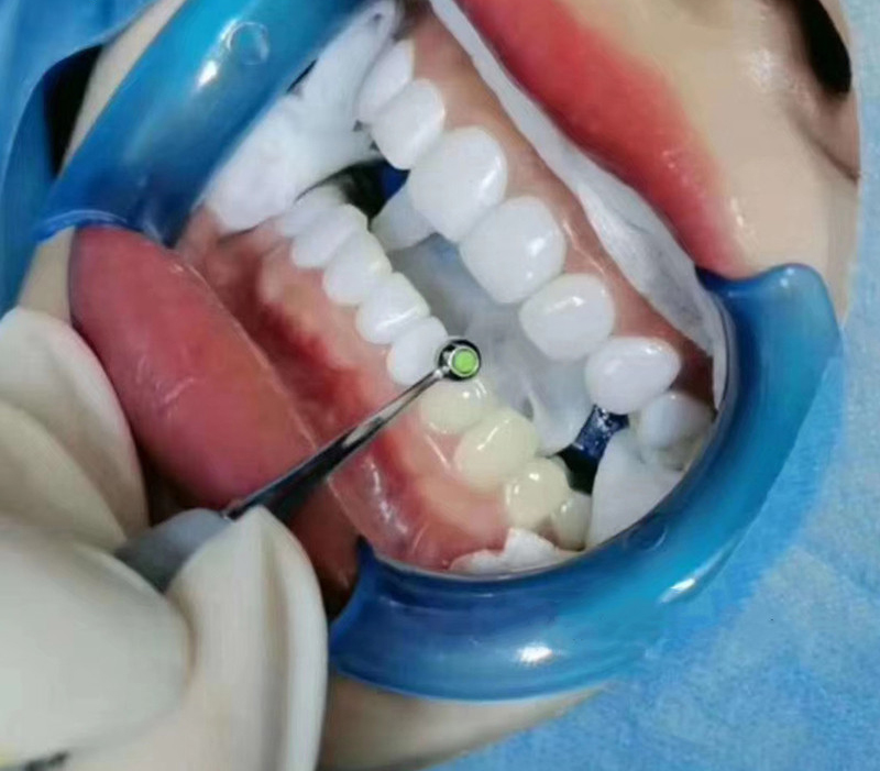 Dental Resin Filling Spatula D - Teeth Whitening Foam Toothpaste incelemesi ve fiyatı