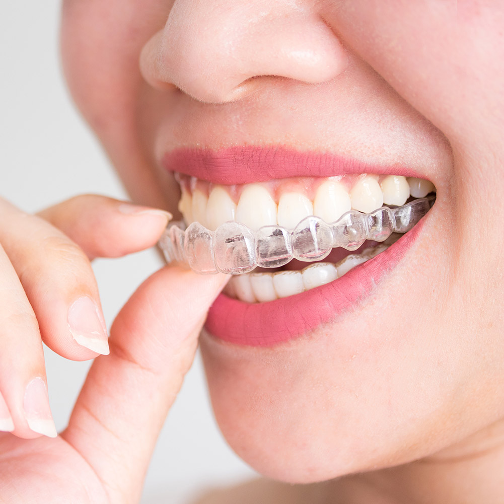 2/4pcs Professional Tooth Orth - Teeth Whitening Retainer incelemesi ve fiyatı