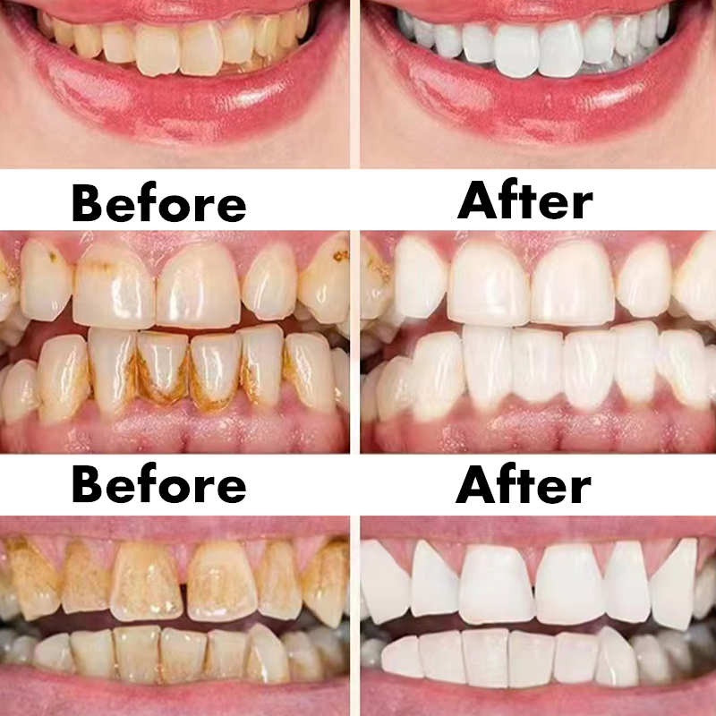Teeth Whitening Pen Dental Ess - Teeth Whitening Serum incelemesi ve fiyatı
